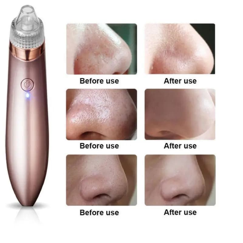 Blackhead Remover Face Acne Black Dot Pimple Electric Blackhead Vacuum Cleaner Pore Skin Care Tool Machine 4 Replacement Head (rechargeable)